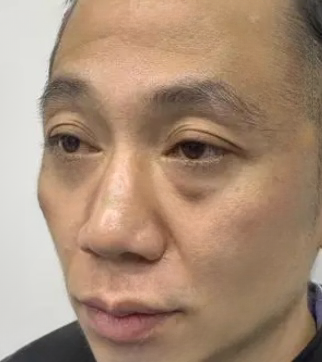 去眼袋手术