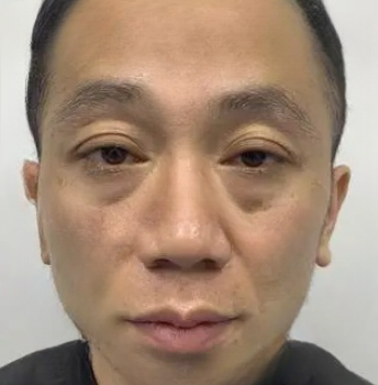 去眼袋手术