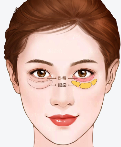 去眼袋手术
