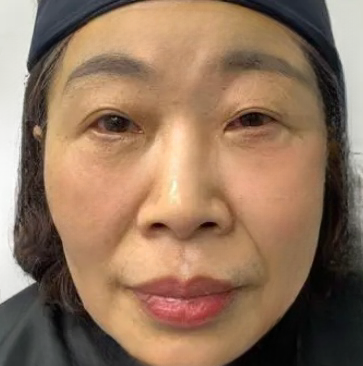 去眼袋手术