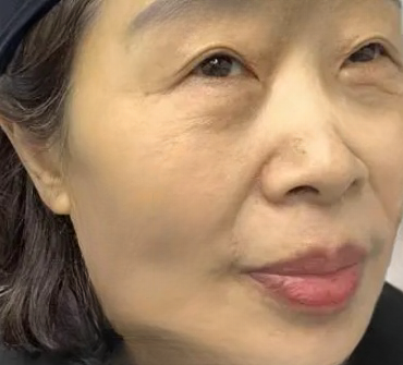 去眼袋手术