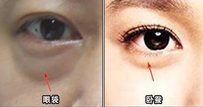 去眼袋手术
