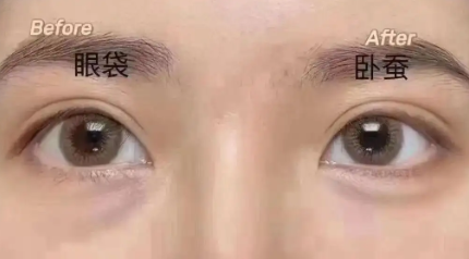 去眼袋手术