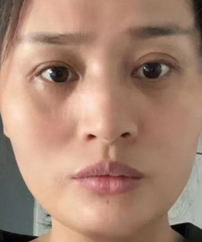 去眼袋手术