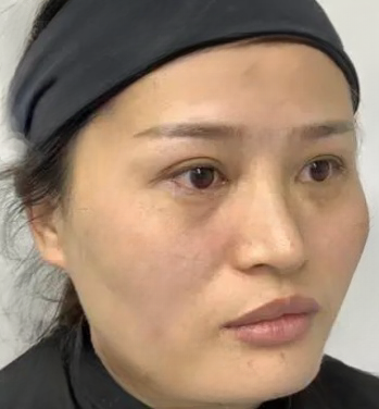 去眼袋手术