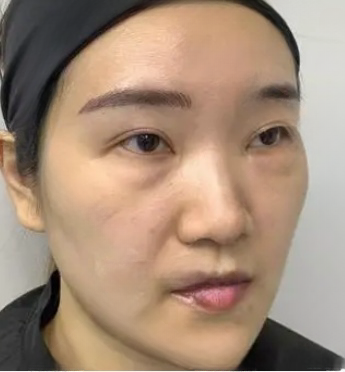 去眼袋手术