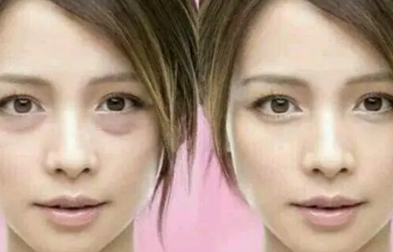 去眼袋手术