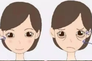 去眼袋手术