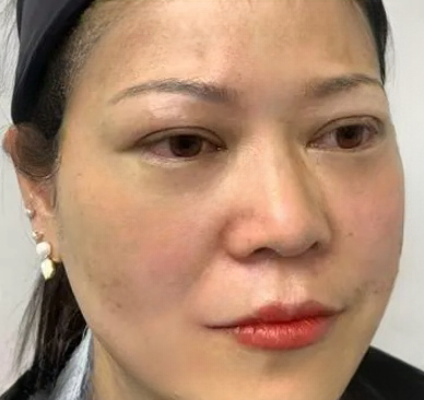 去眼袋手术