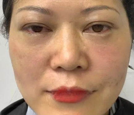 去眼袋手术