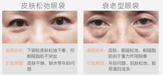 去眼袋手术