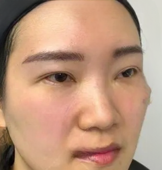 去眼袋手术