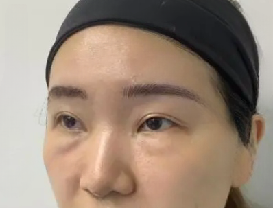 去眼袋手术