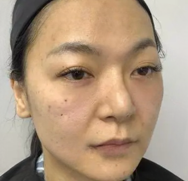 去眼袋手术