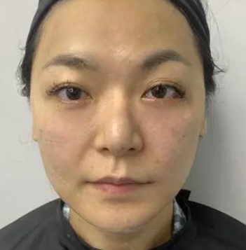 去眼袋手术