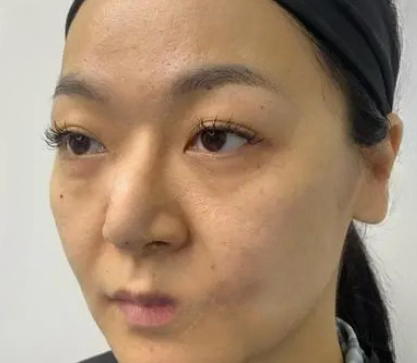 去眼袋手术
