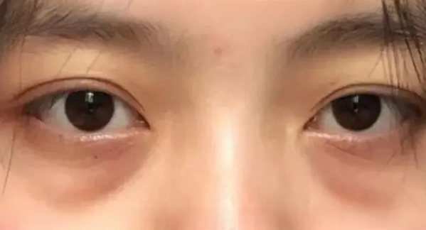 去眼袋手术