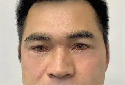 去眼袋手术