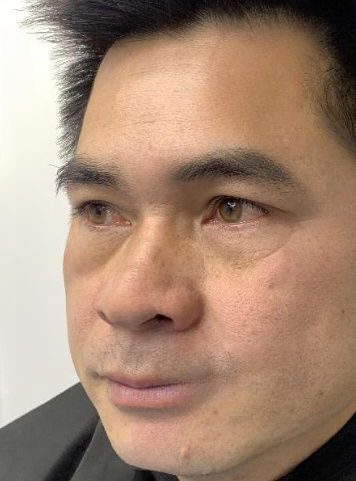 去眼袋手术