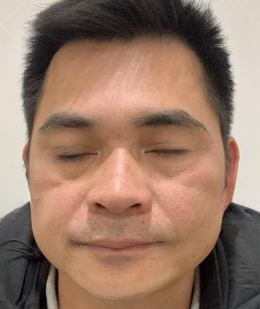 去眼袋手术