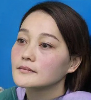 去眼袋手术