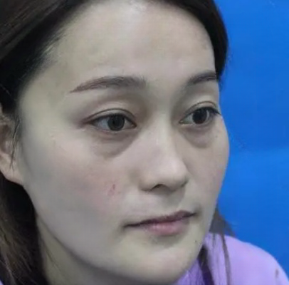 去眼袋手术