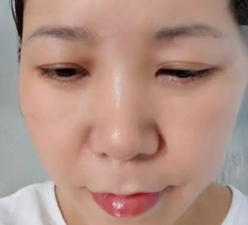 去眼袋手术