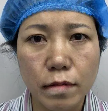 去眼袋手术
