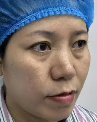 去眼袋手术