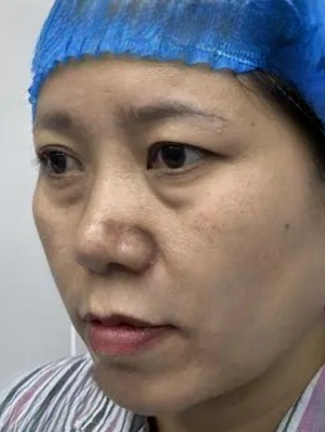 去眼袋手术