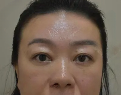 去眼袋手术