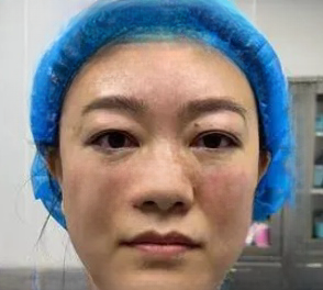 去眼袋手术