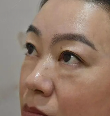 去眼袋手术