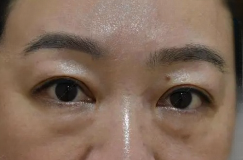 去眼袋手术