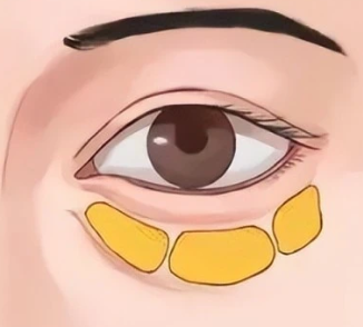 去眼袋手术