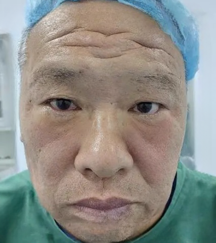 去眼袋手术