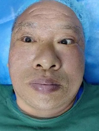 去眼袋手术