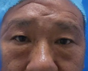 去眼袋手术