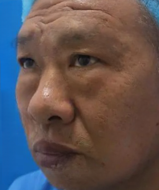 去眼袋手术