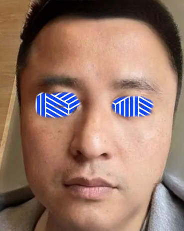 去眼袋手术
