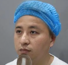 去眼袋手术