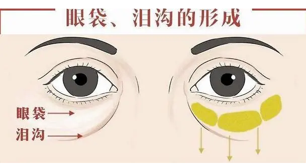去眼袋手术