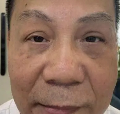 去眼袋手术
