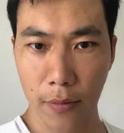 去眼袋手术