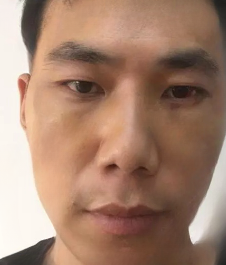 去眼袋手术