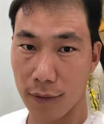 去眼袋手术