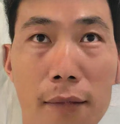 去眼袋手术