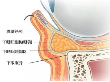 去眼袋手术