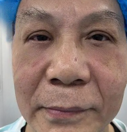 去眼袋手术