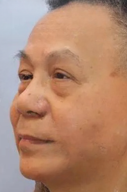 去眼袋手术